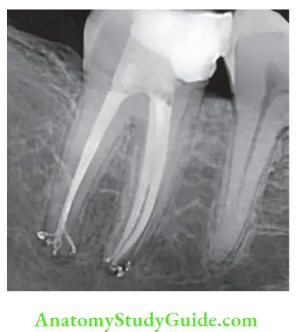 Internal Anatomy apical delta in mandibular second molar