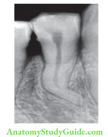 Internal Anatomy dilacerated root of mandibular premolar