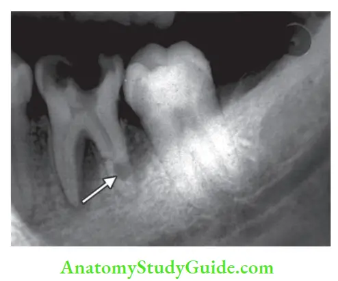 Internal Anatomy internal resorption in distal rooth of mandibular molar.