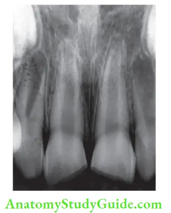 Internal Anatomy open apex of maxillary incisor tooth.