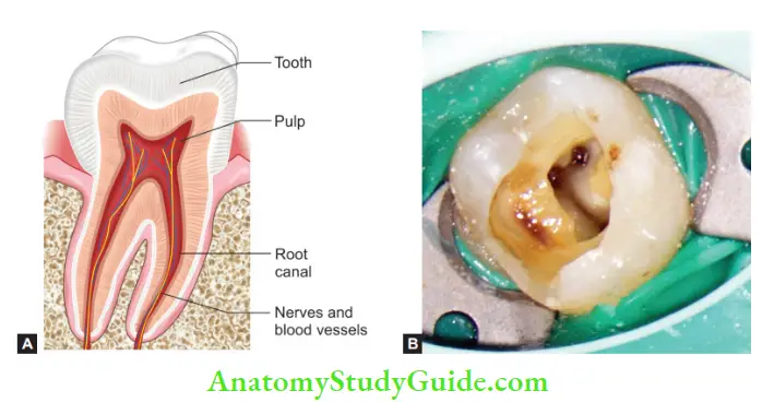 Internal Anatomy pulp chamber and root canal in a tooth;Access cavity of maxillary fist molar showing roof and flor of chamber.
