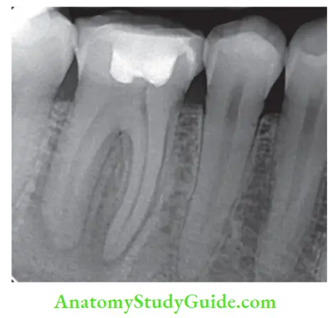 Internal Anatomy root canal anatomy of mandibular molar and premolars.