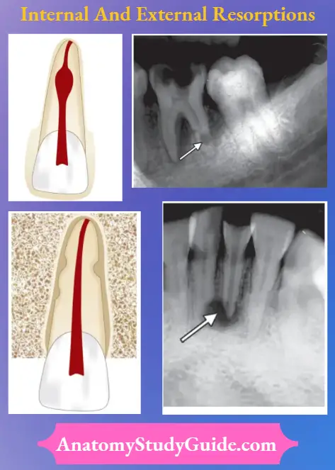 Internal And External Resorptions