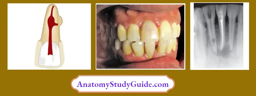 Internal Resorption Clinical Features