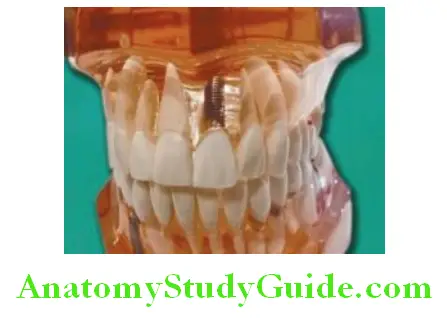Introduction To Implant Prosthesis crown prothesis is fixed on implant abutment