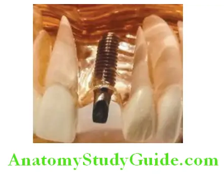 Introduction To Implant Prosthesis dental implant the root of the tooth and provides foundation