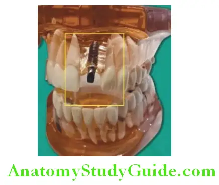 Introduction To Implant Prosthesis model showing single tooth replacement with implant