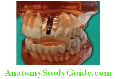 Introduction To Implant Prosthesis placements of implant and implant abutment on it