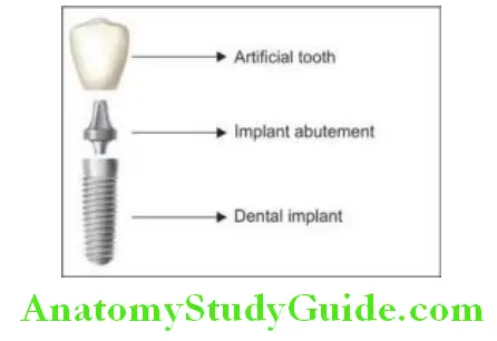 Introduction To Implant Prosthesis root from dental implant is placed in alveolar bone