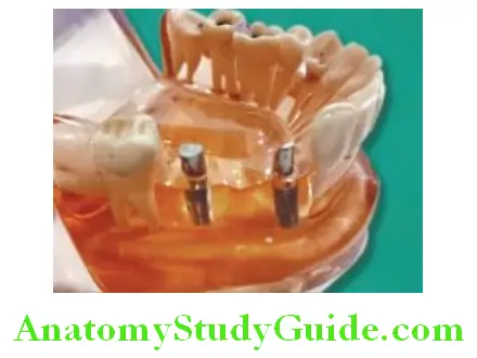 Introduction To Implant Prosthesis two implants in position with abutments on them