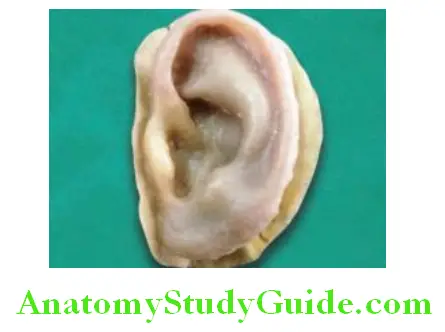 Introduction To Maxillofacial Prosthesis ear prosthesis