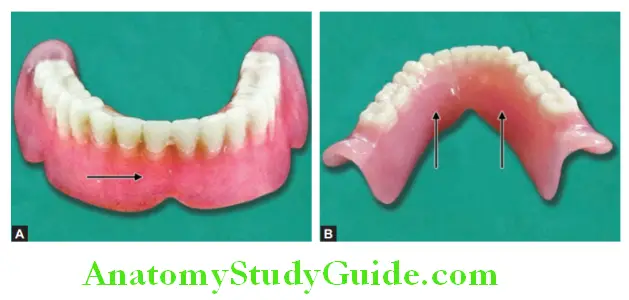 Introduction to Complete Denture polished surface of mandibular denture