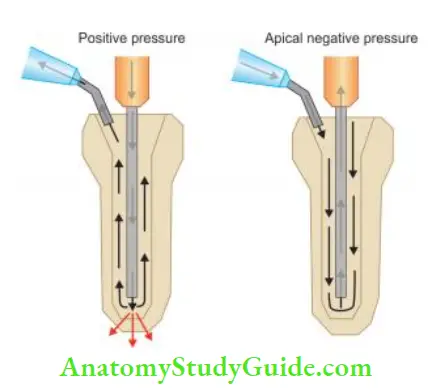Irrigation And Intracanal Medicaments Comparison of positive and apical negative pressure in relation to endodontic irrigation.