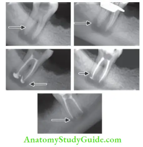 Irrigation And Intracanal Medicaments Management of mandibular molar with periapical infection using Calcium hydroxide as intracanal medicament