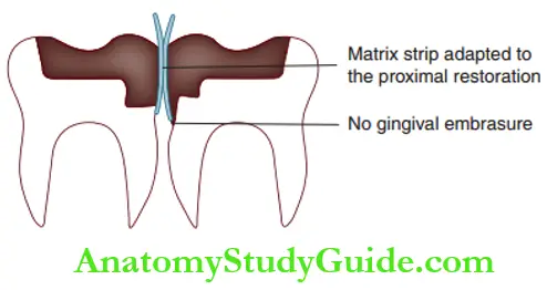Isolation Matricing And Wedging Proximal Restorations Using Only A Matrix With No Wedge