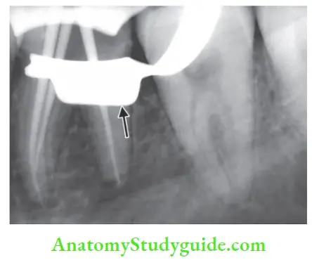 Isolation Of Teeth Radiograph showing radiopaque metallic clamp (arrow).