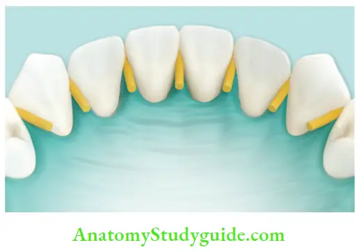 Isolation Of Teeth Wedjets applied on teeth.