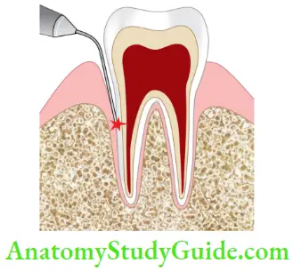 Lasers In Endodontics Schematic Representation Of Decontamonation Of root Surface By Laser