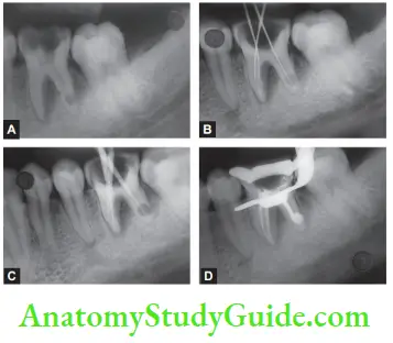 Management Of 36 WithInternal Resorption Preoperative Radiograph, Working Length Radiograph, Master Cone Radiograph, Obturation By Themoplasticized Gutta-percha