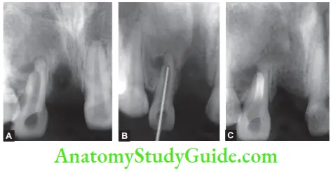 Management Of Case With MTA Radiagraph Showing maxillary Incisor With Open Apex And Perpendicular Radiolucency Associated With It, Working Length Radiograph, MTA Plug Placed Apically
