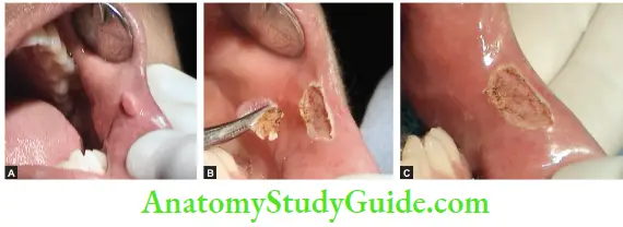 Management Of Fibroma By Laser Treatment Preoperative Photograph, Excision Of Fibroma By Laser, Postoperative Photograph