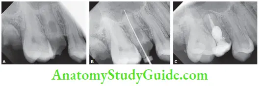 Management Of Maxillary Second Premolar With Internal Resorption-Preoperative Radiograph Working Length Radiograph, Obturation By Themoplasticized Gutta-Percha
