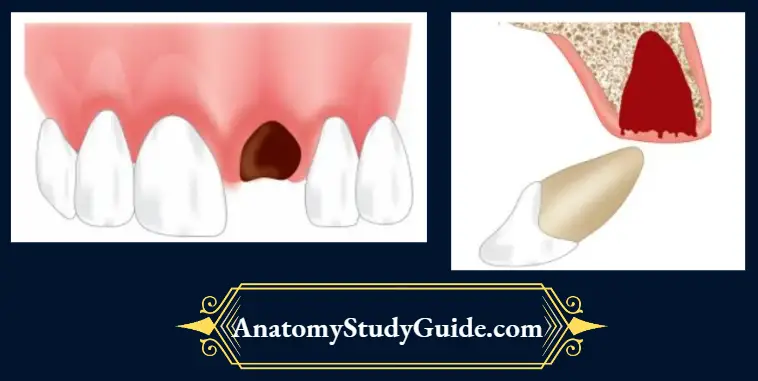 Management-Of-Traumatic-Injuries-Avulsion-of-tooth