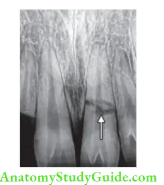 Management Of Traumatic Injuries If an isolated tooth shows excessive mobility, one should suspect root fracture. Radiograph showing root fracture of maxillary central incisor.