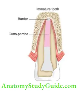 Management Of Traumatic Injuries If hard tissue barrier is formed, root canal can be filed using gutta-percha.