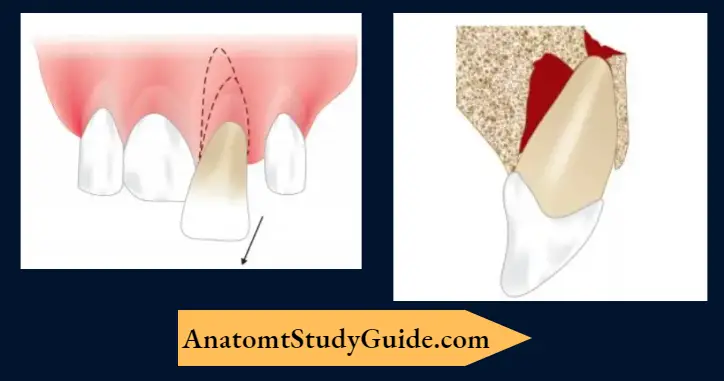 Management-Of-Traumatic-Injuries-Lateral-luxation