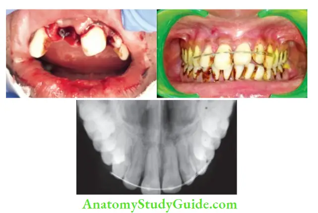 Management Of Traumatic Injuries Management of case with avulsed right maxillary central incisor