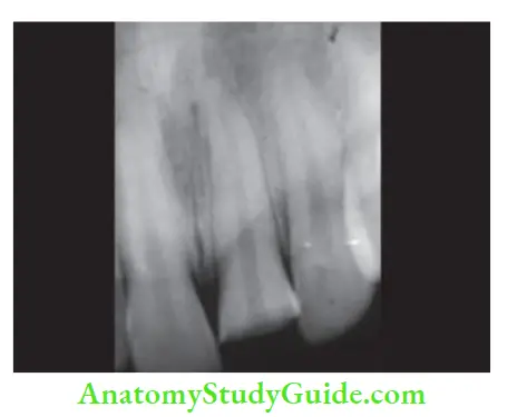 Management Of Traumatic Injuries Radiograph showing complicated tooth fracture.