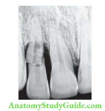 Management Of Traumatic Injuries Radiograph showing root fracture in maxillary incisor.
