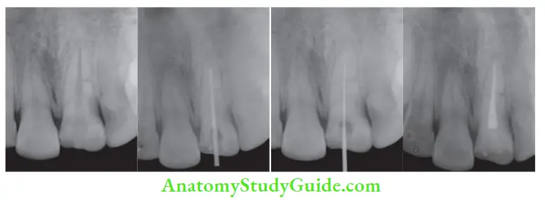 Management Of Traumatic Injuries Root canal treatment of both apical and coronal portion done in the case of root fracture of left maxillary central incisor.
