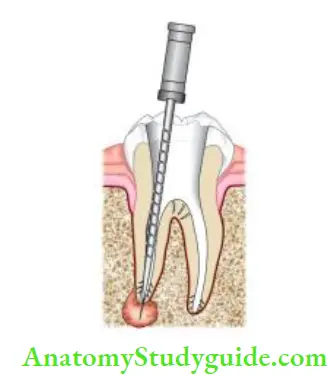 Midtreatment Flare Ups In Endodontics Overinstrumentation is most common cause of midtreatment flre-ups.