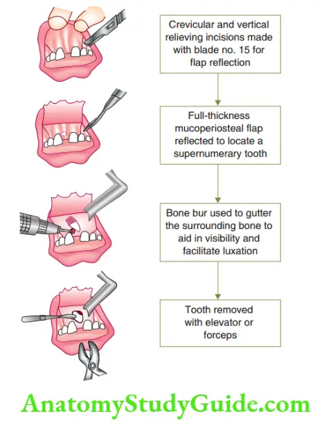 Minor Oral Surgical Procedures Extraction of an unerupted supernumerary tooth