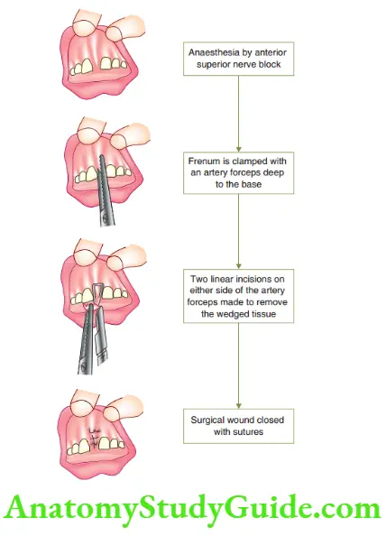 Minor Oral Surgical Procedures Frenectomy procedure