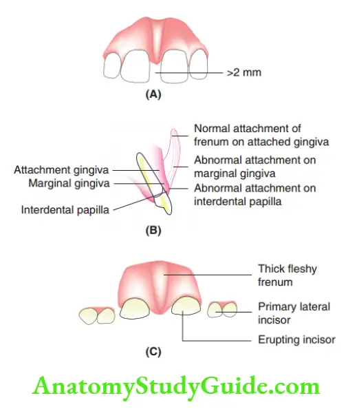 Minor Oral Surgical Procedures Indications of frenectomy