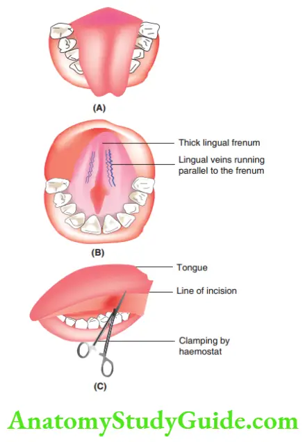 Minor Oral Surgical Procedures Lingual frenectom