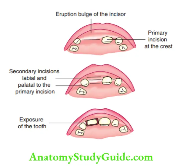 Minor Oral Surgical Procedures Operculectomy