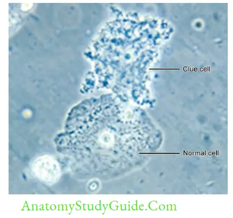 Miscellaneous Bacteria Notes Wet mount of vaginal secretion depicting clue cell