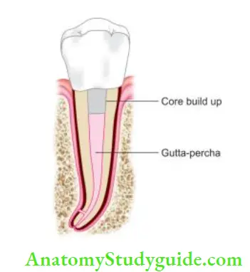Obturation Of Root Canal System Diagrammatic representation of an obturated tooth.