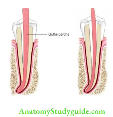 Obturation Of Root Canal System Gutta-percha showing tight fi in middle and space in apical third; Gutta-percha cone showing tight fi only on apical part of the canal.