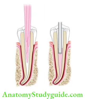 Obturation Of Root Canal System Lateral compaction of gutta-percha;Vertical compaction of gutta-percha.