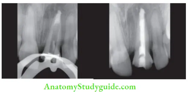 Obturation Of Root Canal System MTA plug given for apical stop; Obturation done using gutta-percha and MTA