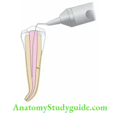 Obturation Of Root Canal System Obturation using Endotec II device