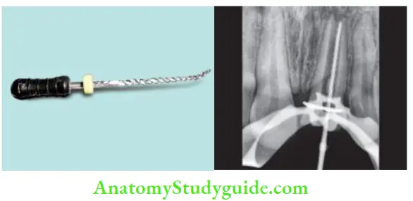 Obturation Of Root Canal System Old gutta-percha removed; working length radiograph