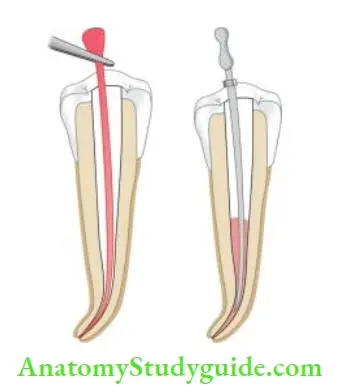 Obturation Of Root Canal System Place the softened cone in the canal; Compact the cone using spreader and place the accessory gutta-percha cones