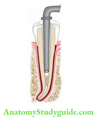 Obturation Of Root Canal System Placement of Ca(OH) 2 in the canal.