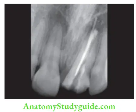Obturation Of Root Canal System Radiograph showing overextended obturation in maxillary central incisor beyond the apex.